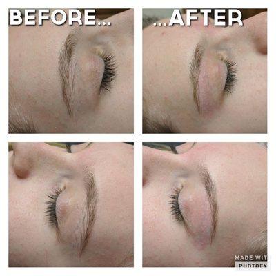 Eyebrow before and after