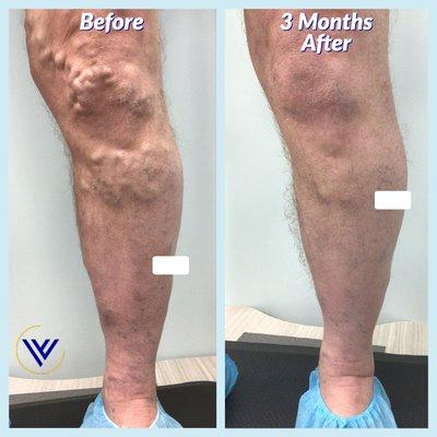 Before And After Varicose Vein Treatment