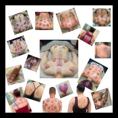 Cupping Therapy