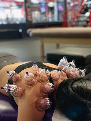 Cupping.