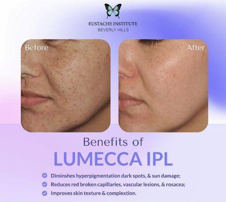 Lumecca IPL