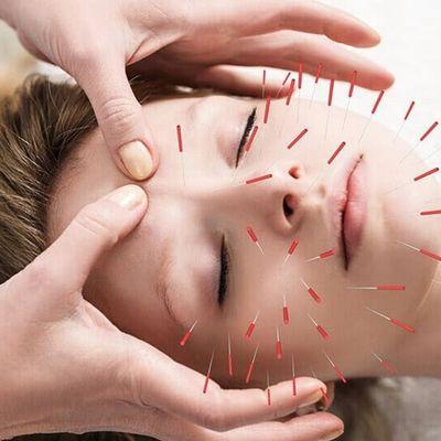 Acupuncture