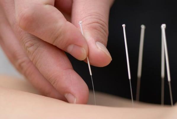 Acupuncture in Anaheim