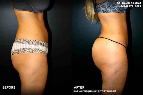 Beverly Hills Butt Lift  Procedure done @ Beverly Hills Aesthetic Surgical Institute by Dr. D. David Saadat MD