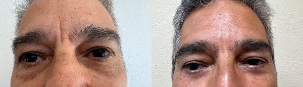 Lower eyelid surgery (blepharoplasty) before and after results of patient a few weeks post op.