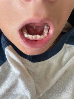 The bottom teeth that had braces on them.