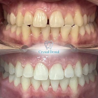 Invisalign and Teeth Whitening results - a brand new smile for our lovely patient!