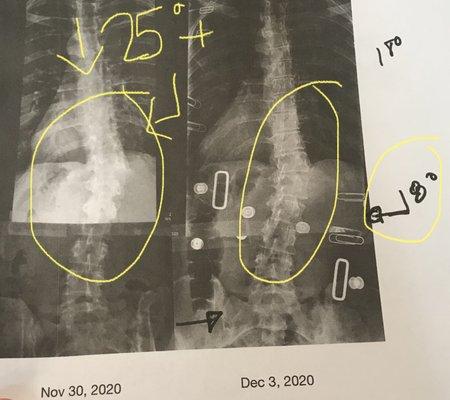 Left: first day, no exercises/no brace Right: Day 4: start of rotational correction and 7-10 degree curve improvement (thoracolumbar)