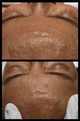 Top: Dehydration skin
Below: Post galvanic hydration into the skin.