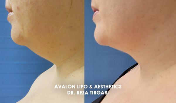 Before & After Liposuction with Dr. Tirgari - www.lipoandaesthetics.com - Neck / Chin