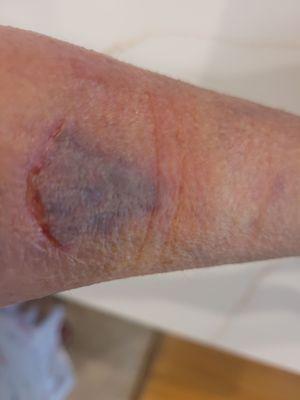 Forearm injury due to assault in Harris Teeter Nexton parking lot on August 29th.