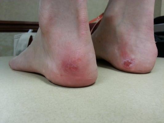 Damage from pedicure