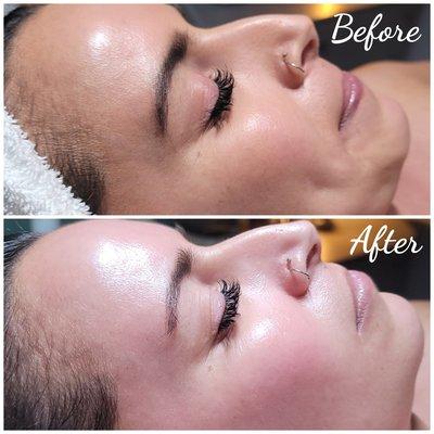 Hydro Glo Facial before and after. Instant results. No down time.