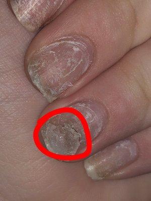 An up close view of my cracked, bruised and ugly ring finger after removing the acrylics!! Disgusting!!