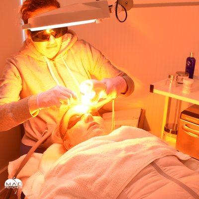 Laser Treatments, Scarlet RF Microneedling