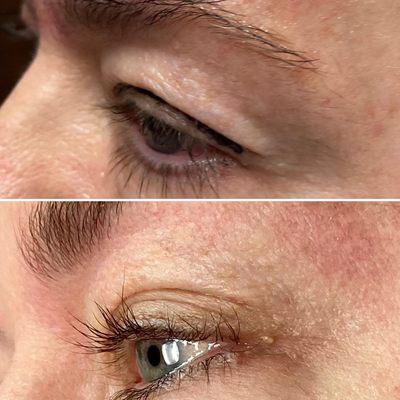 Before and after upper eyelid plasma pen treatment with dramatic results