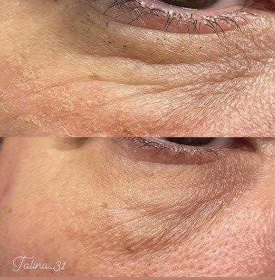 Microneedling Before & After