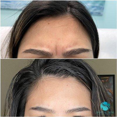 Before & After Botox (glabella/between the brows)