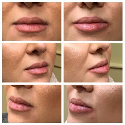 Restylane Lip Filler