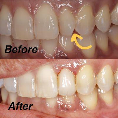 We can change the shape of the tooth without braces!
This rotated tooth was straightened with a crown!