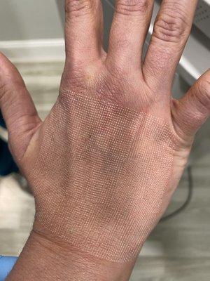 CO2 laser of the hand immediately after treatment.