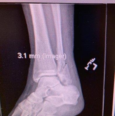 Fractured Ankle