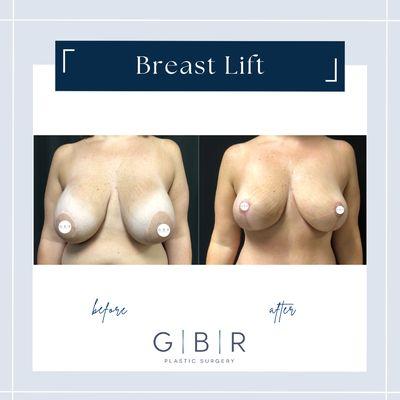 Mastopexy "breast lift"