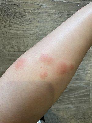 BED BUG BITES