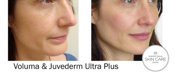 Juvederm Ultra for Lips