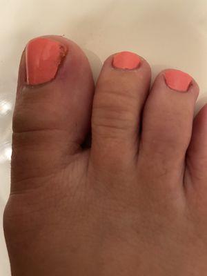 Toe infected