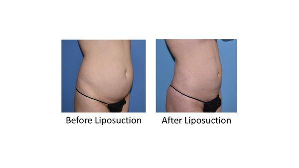 This patient received liposuction of her full abdomen and hips.