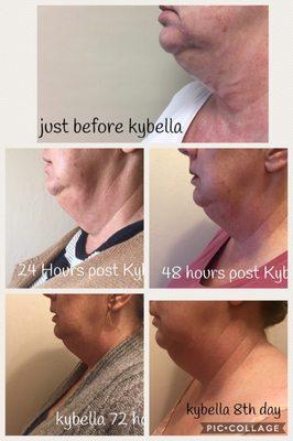 Kybela progression