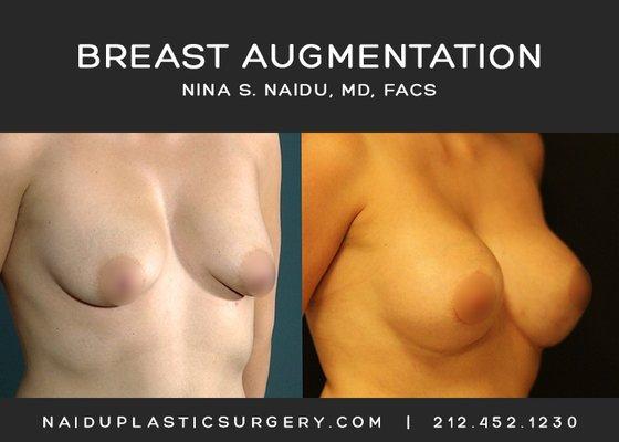 Nina S. Naidu, MD FACS  (212) 452-1230  http://www.naiduplasticsurgery.com   IG: https://www.instagram.com/drnaidu_plasticsurgery/