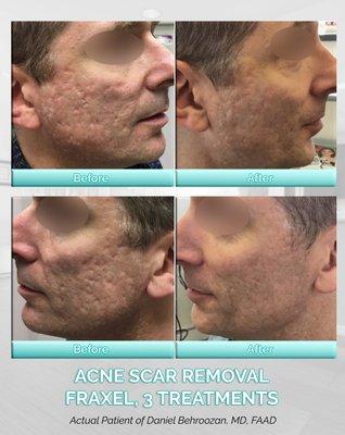 Acne scars can be a very difficult condition to treat. Options such as the Fraxel laser can be used to reduce the scarring from acne.