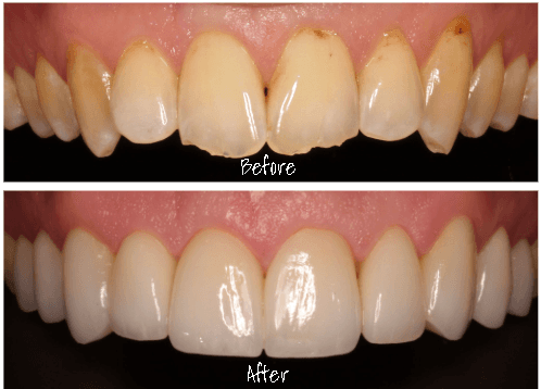 Wear and bite corrected with 10 custom porcelain veneers!