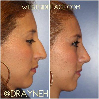 Female Rhinoplasty