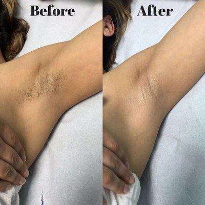 Get ready for the Summer! Underarm waxing before & after