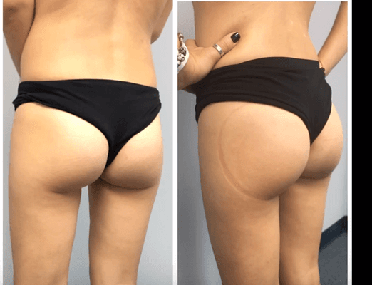 Non Surgical Brazilian Butt Lift