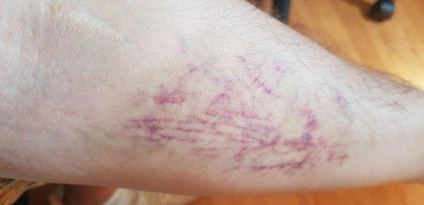 The work of an Inexperienced nurse. He kept stabbing my arm looking for a vein..worst experience i ever had in a hospital.