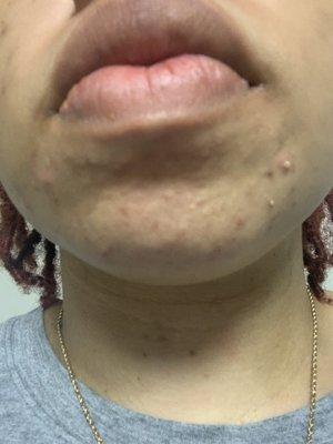 Pustules less than 24 hours after extractions