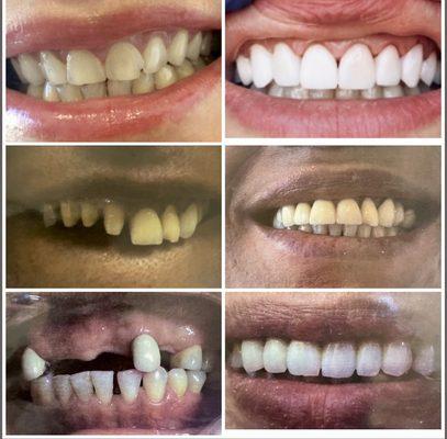 Cosmetic Dentistry before & after photos