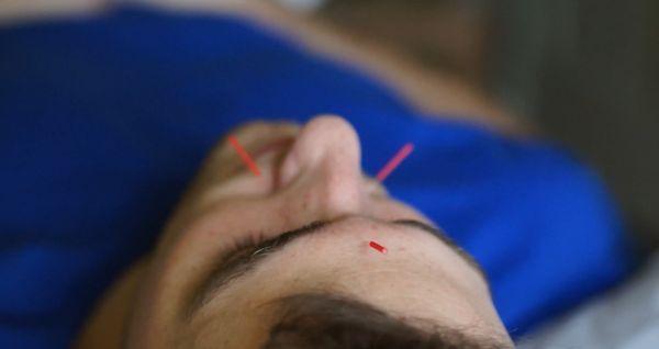 Acupuncture for stress & anxiety.