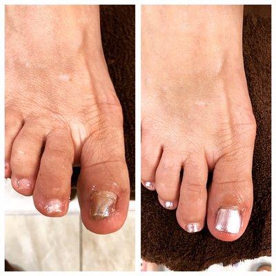 Toe reconstruction.. even if your toes are not perfect.. I can fix them