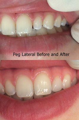 "Peg" lateral.  A common genetic anomaly where one front tooth is smaller than the others.  Fixed with a same day Cerec crown!