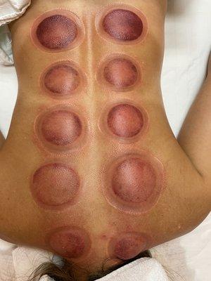 Cupping Massage