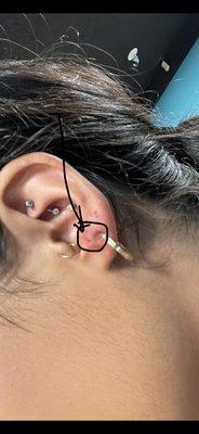 The circled dot is the hole I was left with.  He put the needle going up so it went inside my ear instead of coming out through the back.