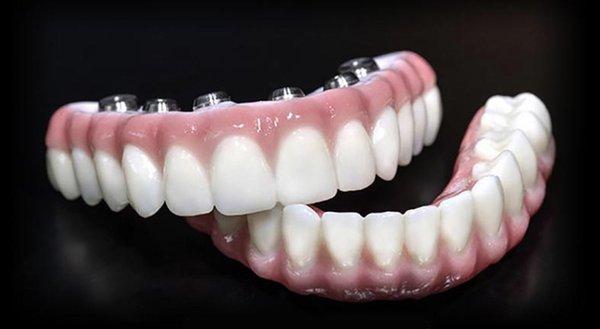 Implant supported Layered Zirconia Hybrid milled from Prettau  porcelain