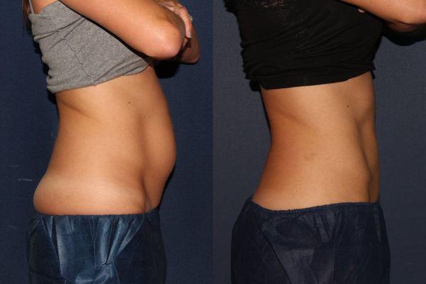 Coolsculpting results