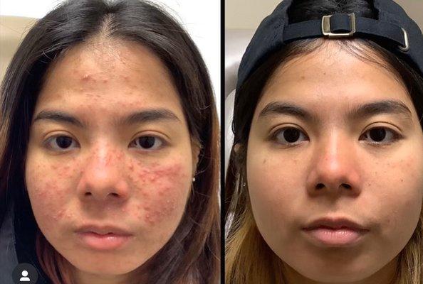 Rosacea Before After