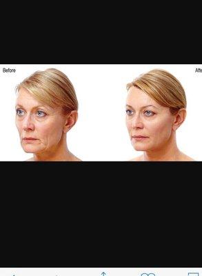 Dermal Fillers